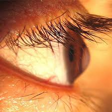 Keratokonus Adana Nivgoz Adana Maya Goz