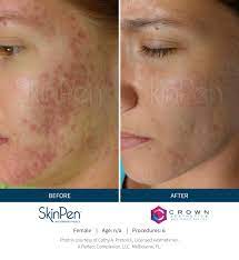 Maybe you would like to learn more about one of these? Skinpen Before And After Skinpen Microneedling Crown Aesthetics