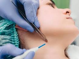 Kebanyakan tahi lalat tidak berbahaya dan tidak sakit. Penjelasan Dokter Tentang Hilangkan Tahi Lalat Pakai Kapur Sirih Sabun Colek