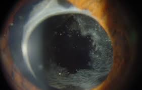 Yag Kapsulotomie Nachstar Institut Fur Augenheilkunde