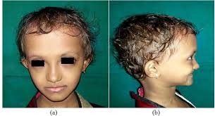 Fried Tooth and Nail Syndrome with Possible Mutation