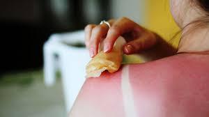 Black tea bags for sunburn. How To Treat Sunburn Naturally Natural Remedies To Soothe Sunburn