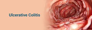 Image result for Ulcerative Colitis