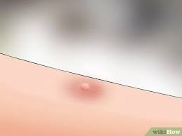 The bite feels like a sharp pain similar to a pinprick. 3 Ways To Identify A Redback Spider Wikihow