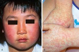 Immunofluorescence detects measles antigens multinucleated giant cells in smears of nasal mucosa low white blood cell count and a relative lymphocytosis in pb measles encephalitis — raised protein, lymphocytes in csf cljnjcål 4. Infectious Disease Obgyn Key