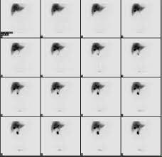 Cholescintigraphy Wikipedia