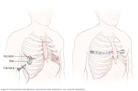 Image result for Pectus Excavatum