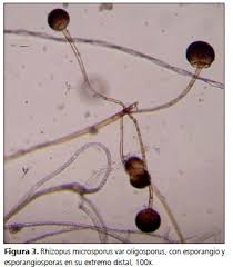 La puerta de entrada es habitualmente el tracto respiratorio. Mucormicosis Cutanea En Un Paciente Inmunocomprometido