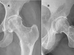 Hip Arthrodiastasis Combined With Core Decompression And Diamond Concept For Postcollapse Femoral Head Avascular Necrosis Bmj Case Reports