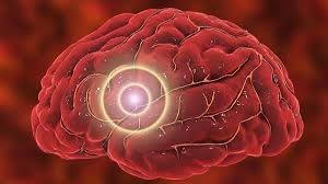 O aneurisma é uma área frágil na parede de um vaso sanguíneo que se torna uma protuberância e pode aumentar de tamanho. Que Es El Aneurisma Cerebral Sintomas Causas Y Como Tratar La Enfermedad