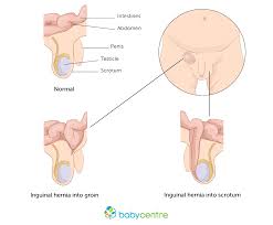 Image result for Inguinal hernia child