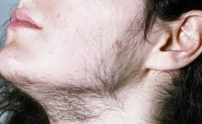 Image result for Hypertrichosis