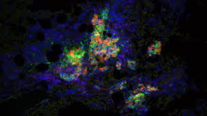 Some of these symptoms are. New Search And Destroy Treatment Extends Life In Advanced Prostate Cancer The Institute Of Cancer Research London