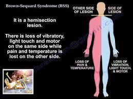 Brown Sequard Syndrome Everything You Need To Know Dr Nabil Youtube