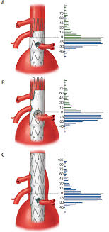 Contact your local cook representative or customer. Modern Complex Stent Graft Designs A Closer Look Endovascular Today