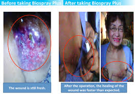 New advances in treatment include taxane chemotherapy, targeted therapies, and the development of more active hormonal therapy drugs. I Survived Stage 4 Breast Cancer Better Health Matters