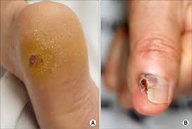 Image result for Acral lentiginous melanoma nail