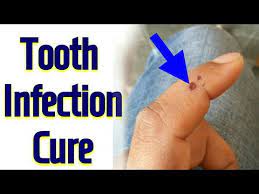 In case you want to use any of the pressure points, you must consult an acupressure expert before taking the action. Single Acupressure Point For Infection In Teeth Tooth Decay Tooth Pain Tooth Infection Hindi Youtube