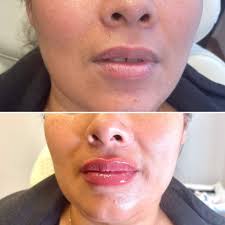 Dermal Fillers