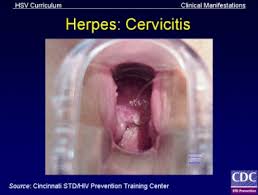 Image result for Friable Cervix