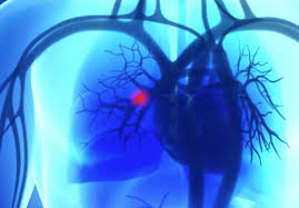 Quali sono i sintomi dell'embolia polmonare? Embolia Polmonare Cause Sintomi E Cure Assocarenews It Quotidiano Sanitario Nazionale