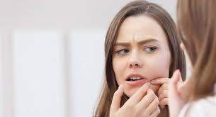 Sivilce Nasil Gecer Sivilce Lekelerine Cozum Memorial