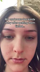 Allergic Reaction to Tinted Eyebrows