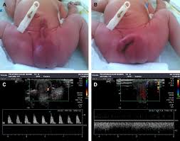 Image result for Priapism