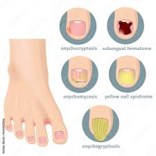 Image result for Onychogryphosis feet
