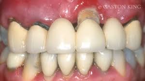 Dental Implants At Bath Bristol Periodontal Clinic