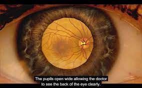 Dilated Eye Exam Animation Diabetic Retinopathy Eye Exam Diabetic Eye Disease