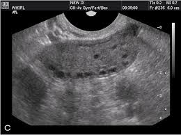 Ovarian cysts with all of the features of ovarian cancer warrant the recommendation of removal of the cyst to definitively determine if it is benign or malignant. Transvaginal Ultrasonography And Female Infertility Glowm