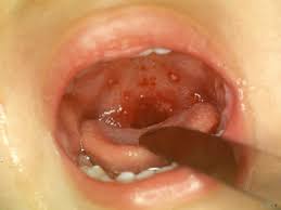 Image result for coxsackie baby