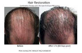 Oral finasteride is a prescription medication for men who have male pattern hair loss, or androgenetic alopecia. Prp Hair Restoration Ei Con Health Wellness Center