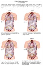 Pin On Mesothelioma Info