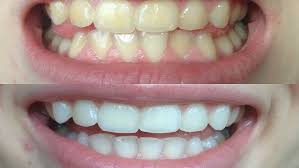 How to whiten teeth reddit. How I Whitened My Very Yellow Teeth Works Before And After Youtube
