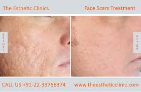 Cost of chicken pox removal depends upon which kind of treatment you will need. Face Scar Removal Mumbai Laser Scar Reduction Treatment Cost India The Esthetic Clinics