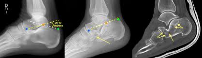 Image result for Calcaneus