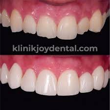 We did not find results for: Veneer Gigi Di Klinik Gigi Joy Dental Klinik Gigi Joy Dental Yogyakarta