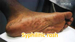 Image result for Syphilis