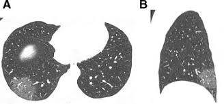 Coronavirus Disease Covid 19 Spectrum Of Ct Findings And Temporal Progression Of The Disease Academic Radiology