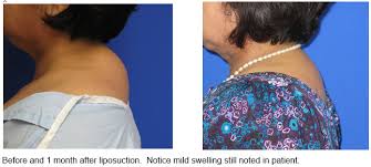 A rounded mass or protuberance, such as the fleshy structure on the back of a camel or of 2. Treating Dorsal Cervical Fat Or The Buffalo Hump Aesthetic Laser Center