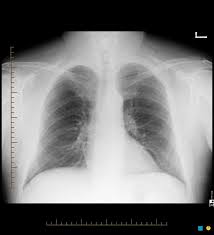 Spot film left upper lobe. Sick Pozzieboy