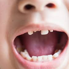 Bite down on dental floss. Children S Teeth Rotting In Their Mouths Because Of Sugary Foods Say Experts Sugar The Guardian