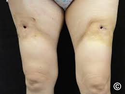 Image result for Panniculitis