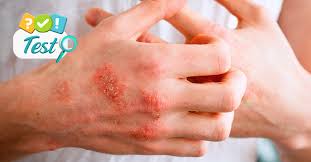 Image result for dermatitis contacta
