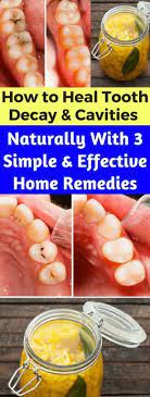 How To Heal Tooth Decay Cavities Naturally With 3 Simple And Effective Home Remedies Seeking Habit Tooth Decay Heal Cavities Cavities