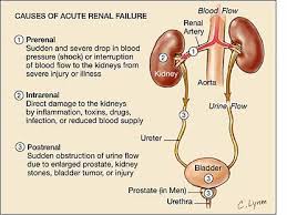 Renal failure is the partial or complete failure of the kidneys to function. Acute Renal Failure Causes Diagnosis And Treatment