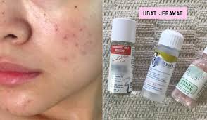 Lidah buaya atau dalam bahasa ilmiah di sebut dengan aloe vera merupakan tanaman obat yang sudah sangat populer khasiatnya untuk perawatan dan kecantikan kulit. Produk Paling Berkesan Menghilangkan Masalah Jerawat Dan Parut