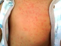 Contents how does a child get roseola? Roseola Infantum Family Health Kidspot New Zealand